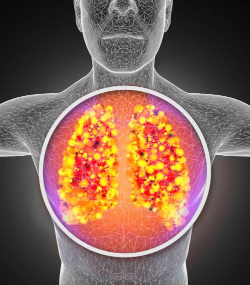 Danni ai polmoni causati dall'amianto